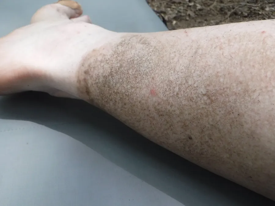 Dirty leg